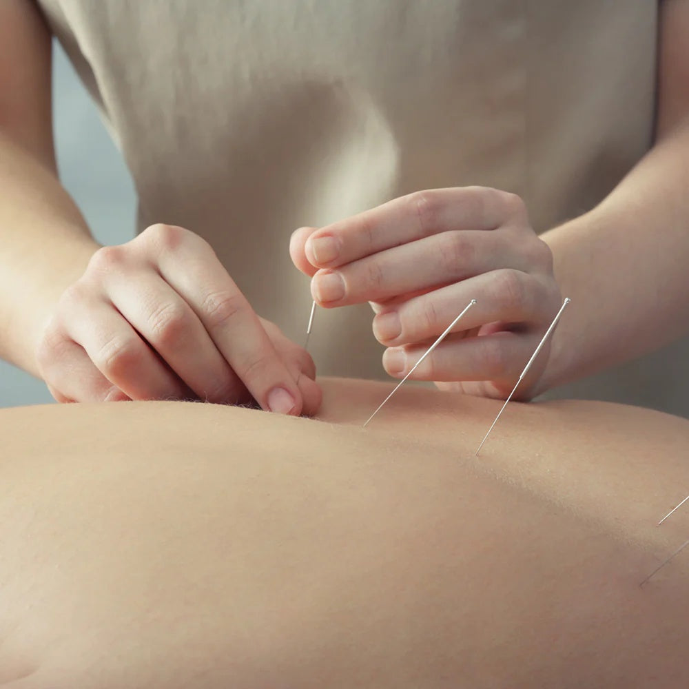 Community Acupuncture